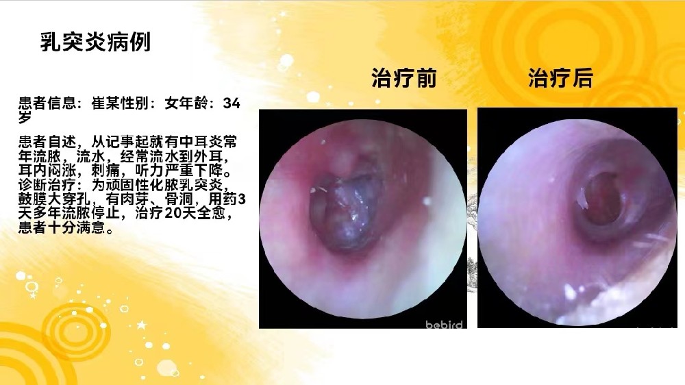 乳突炎病例